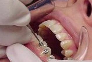 Ortodoncia colocación del aparato